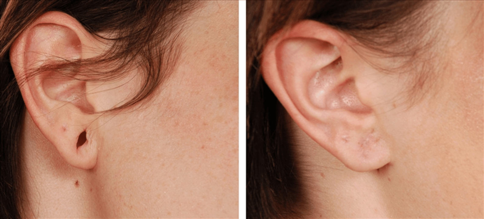 Ear Lobe Repair
