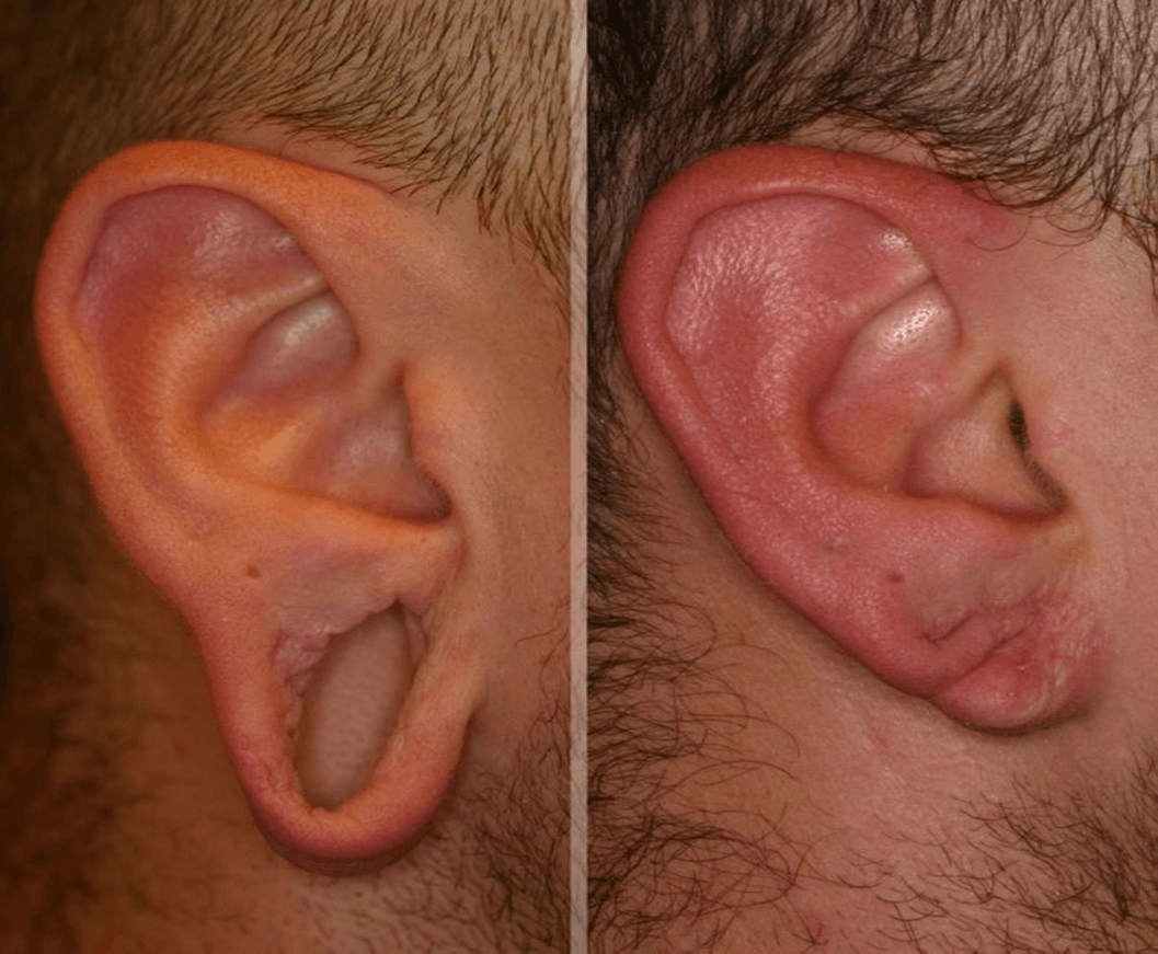 A man 's ear is shown before and after surgery.