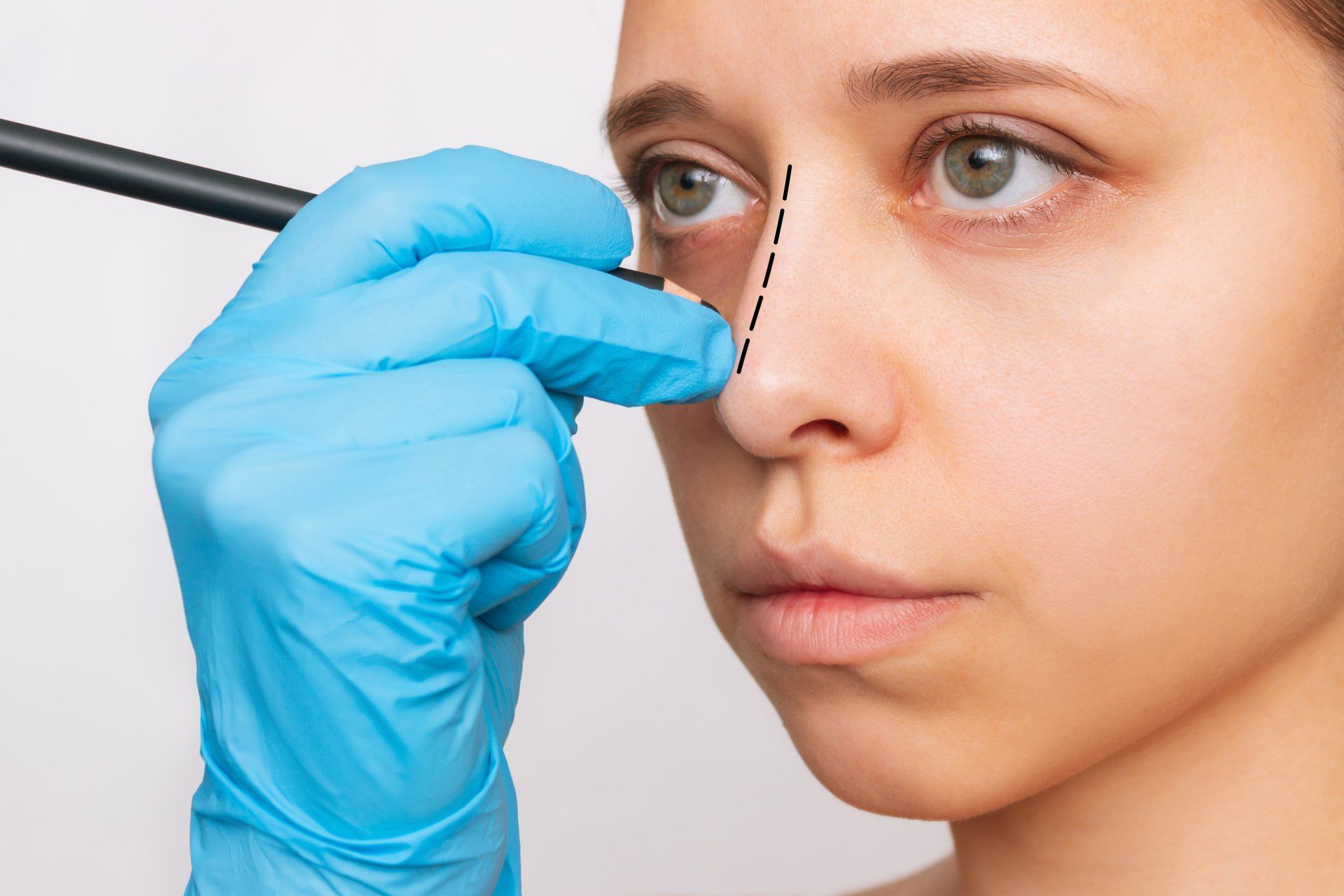 rhinoplasty