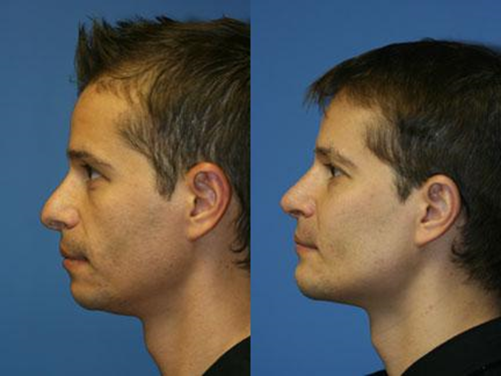 Malarplasty