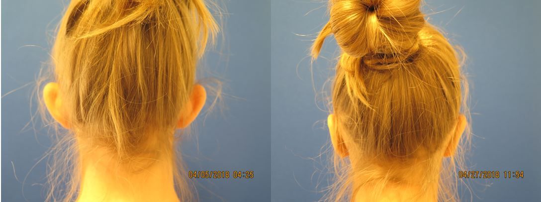Otoplasty