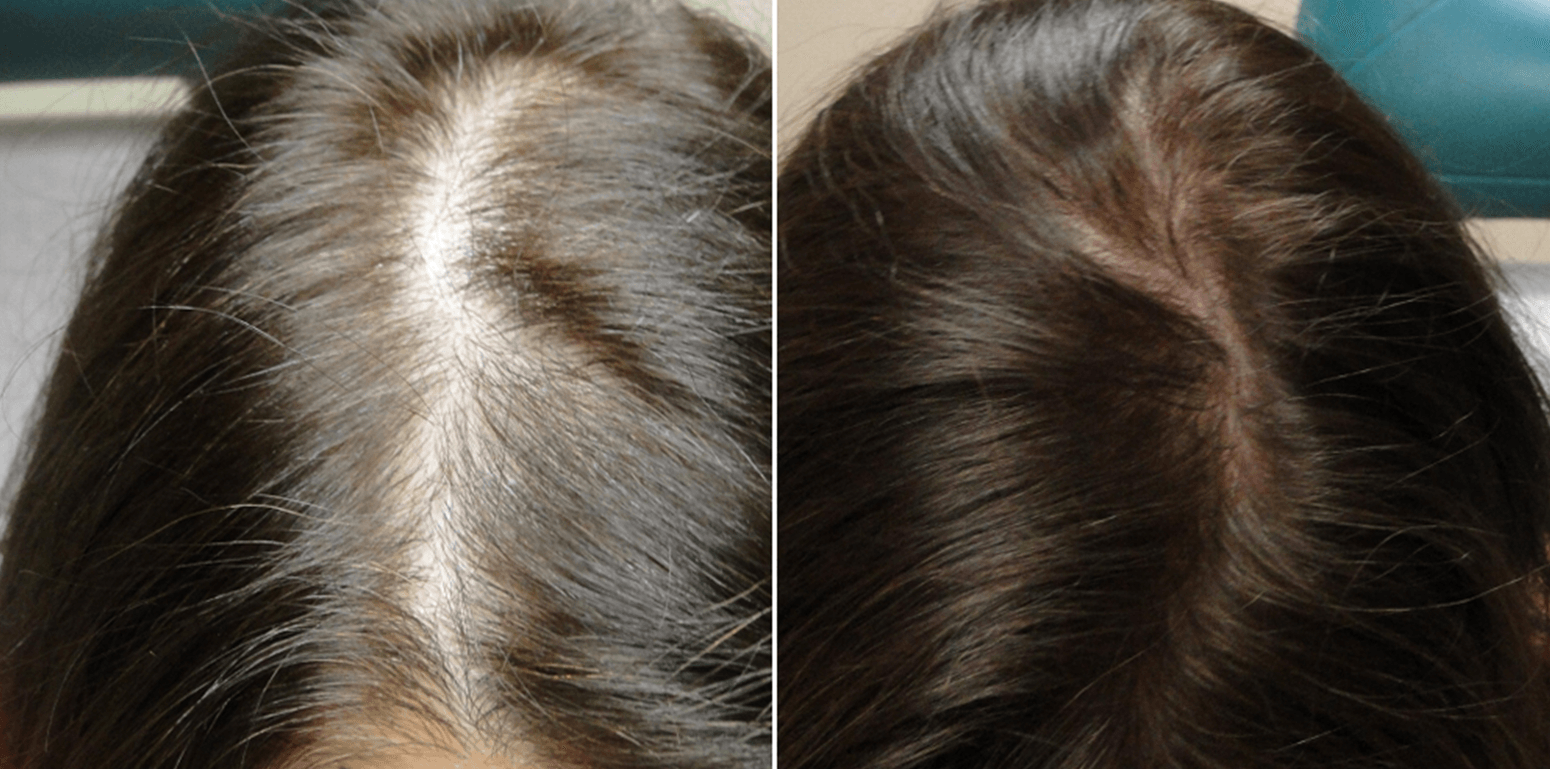 PRP Hair Injection Treatment