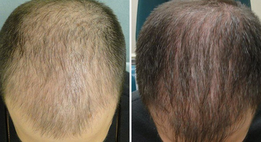 A before and after photo of a man 's hair growth.
