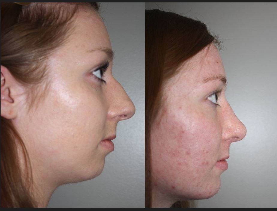 rhinoplasty
