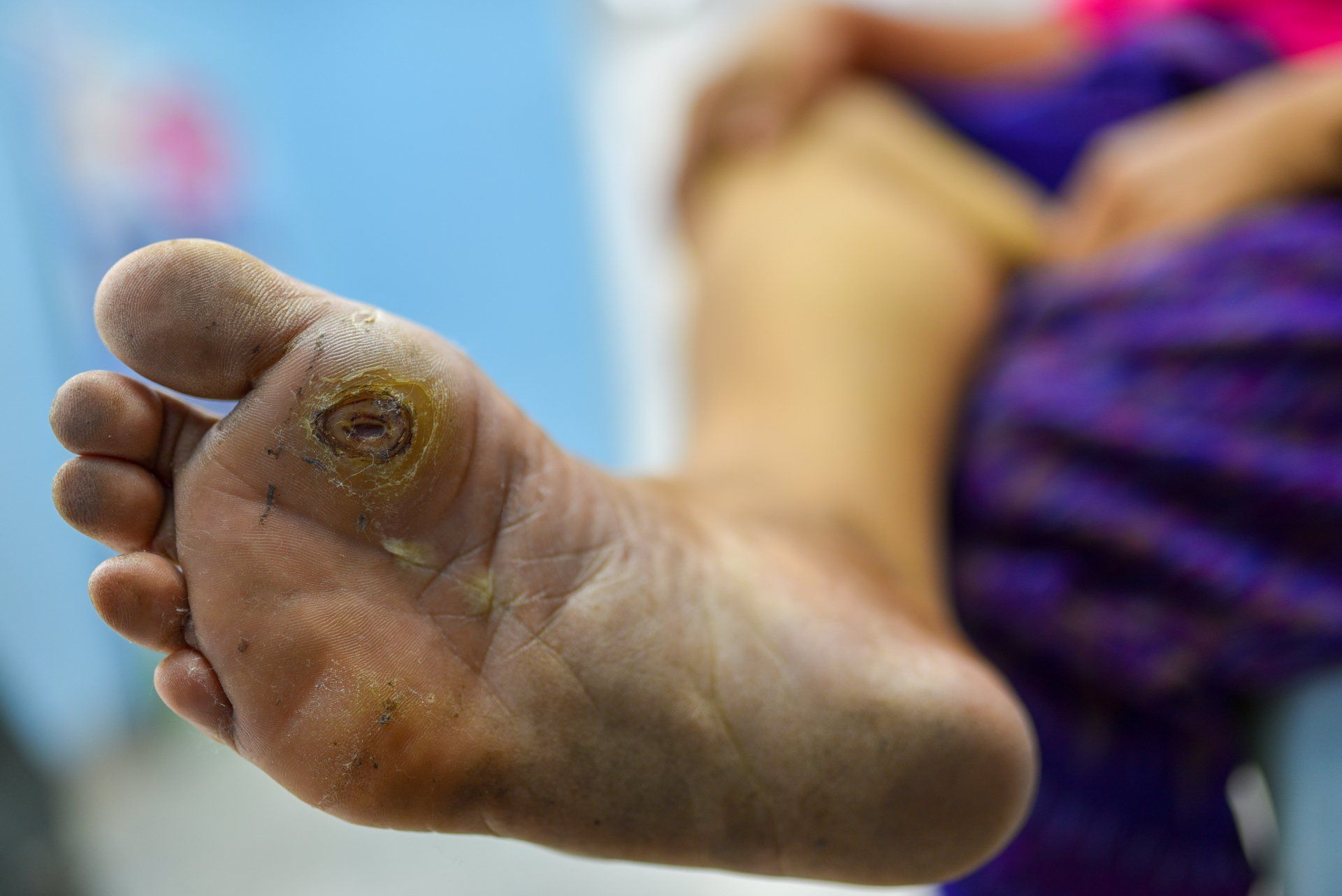 A close up of a person 's foot with a ulcer on it.