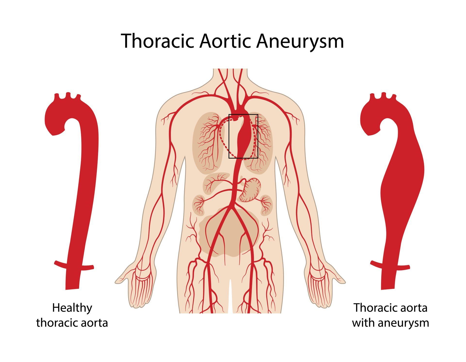 A diagram of thoracic aortic aneurysm and healthy thoracic aorta