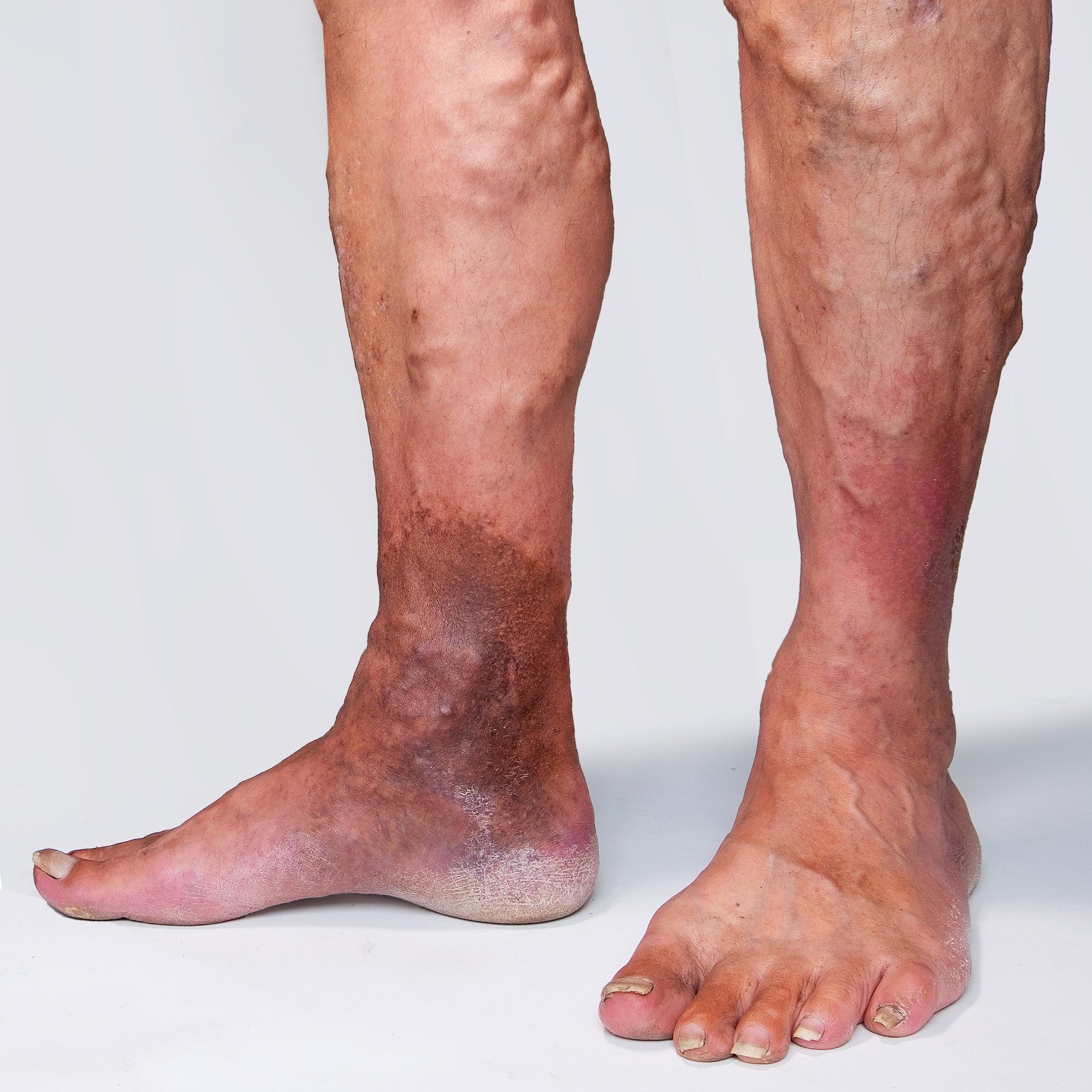 A close up of a person 's legs with varicose veins