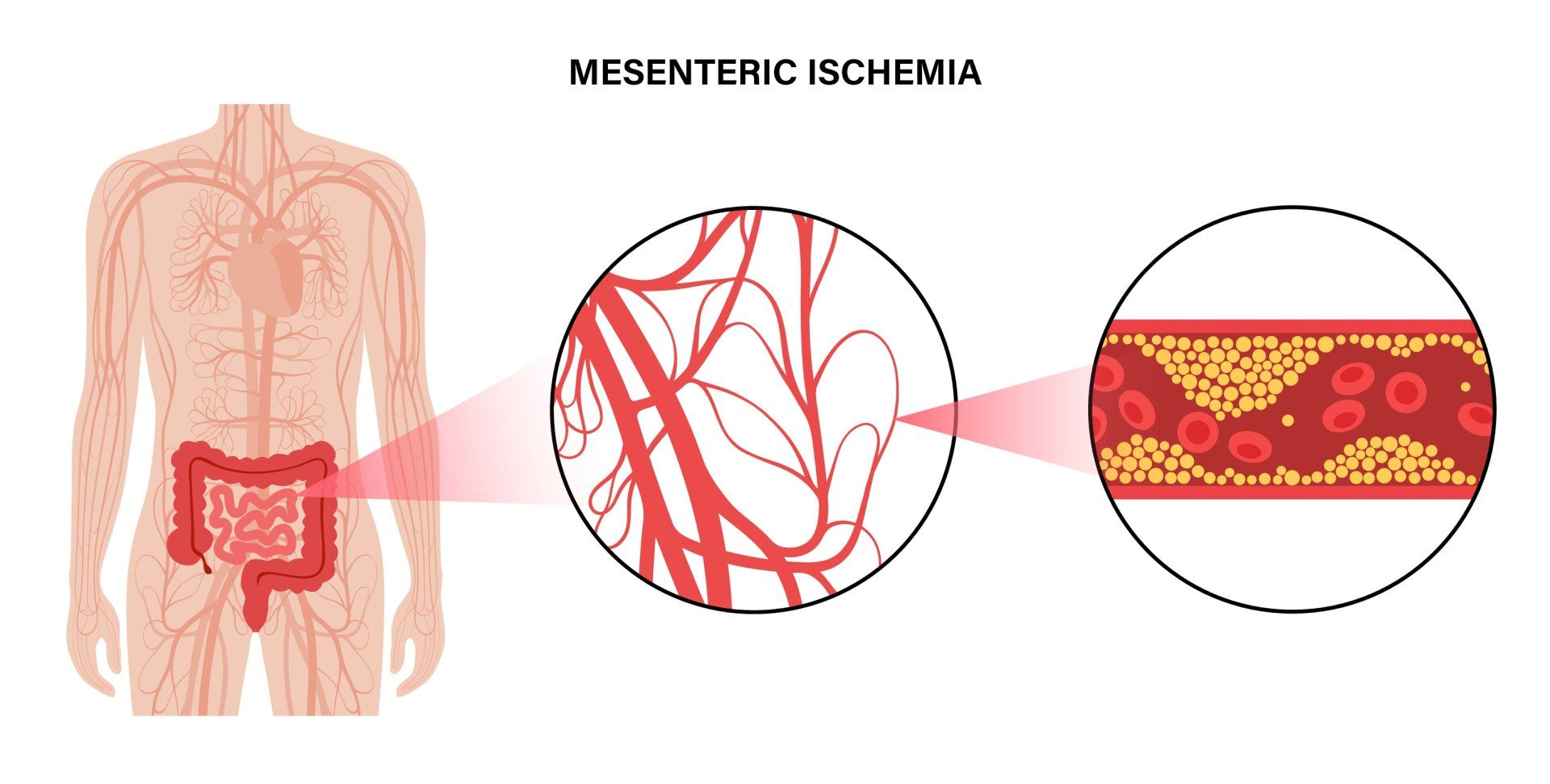A diagram of a person with mesenteric ischemia.