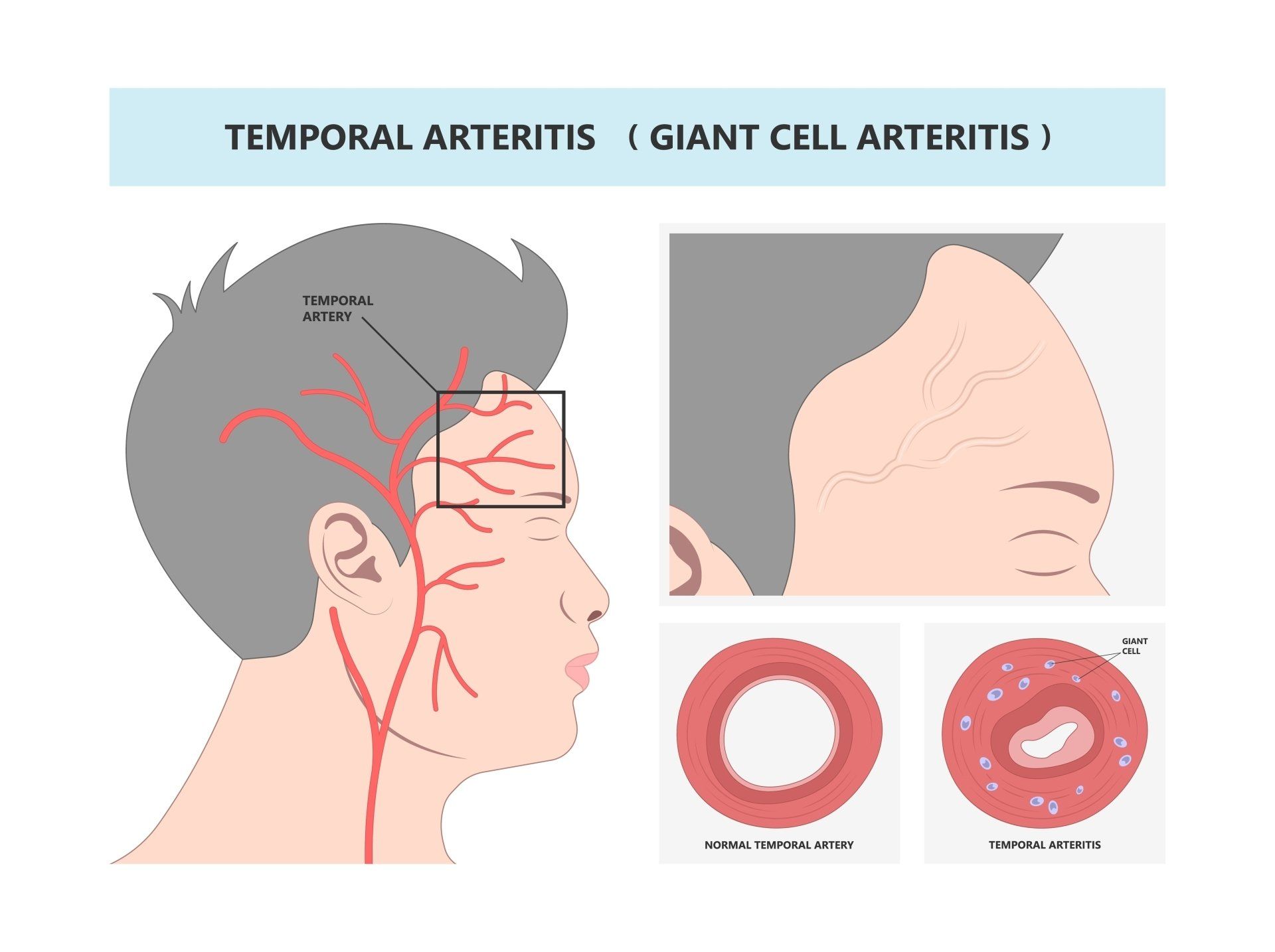 A diagram of a person with temporal arteritis and giant cell arteritis.
