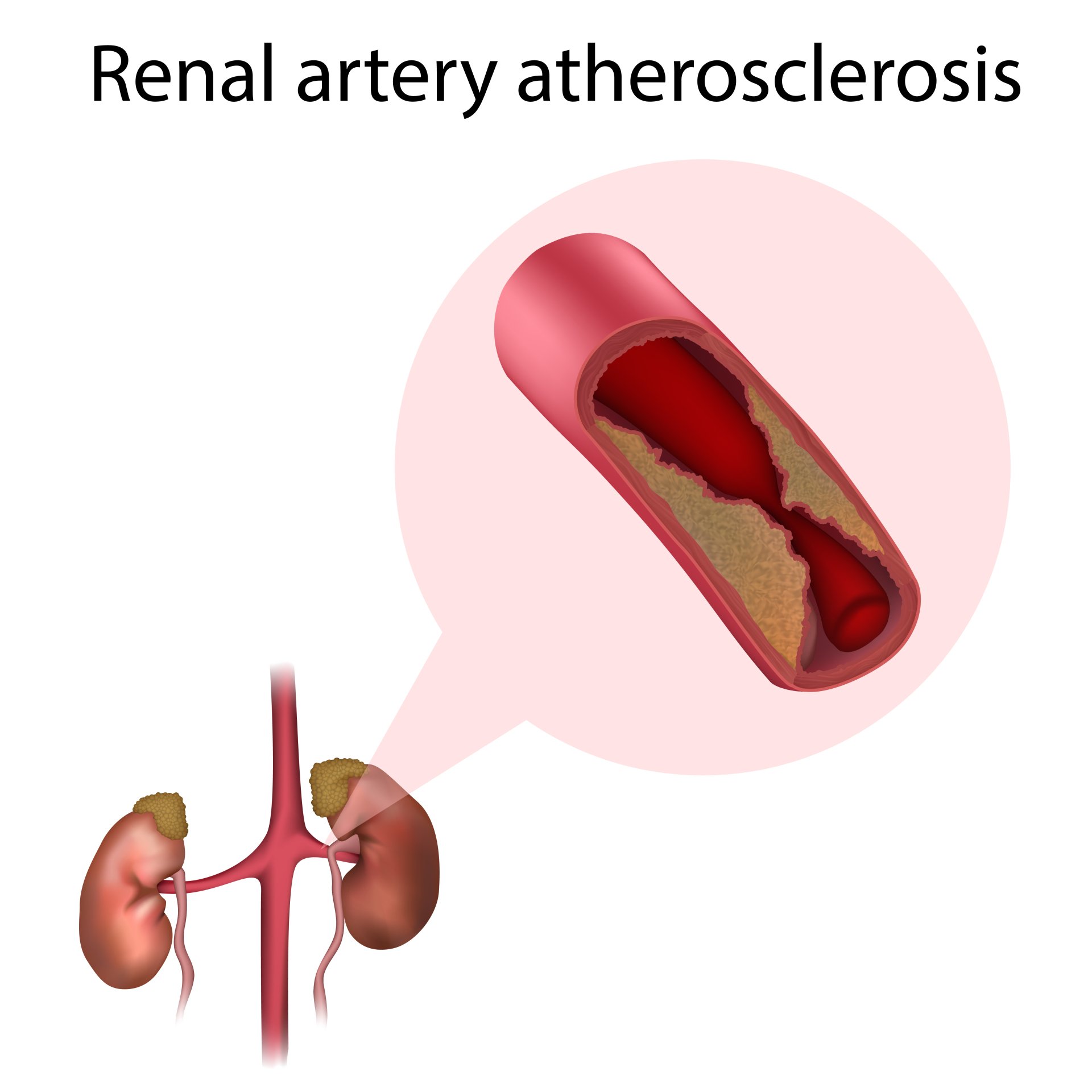RENAL ARTERY STENOSIS visual data 2