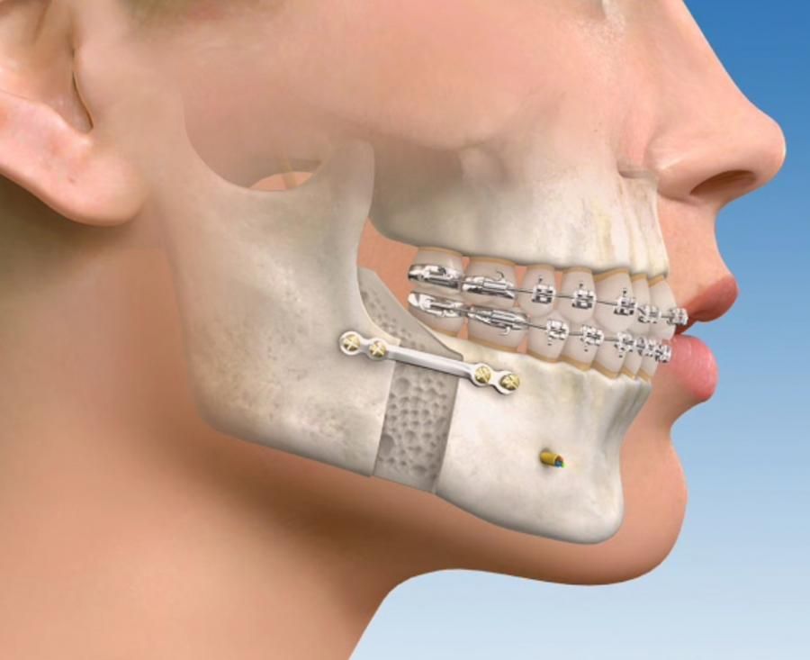 Ilustración médica de una cirugía maxilofacial con aparatos ortopédicos y fijadores metálicos, vista lateral.