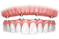 Prótesis dentales superiores e inferiores con cuatro aditamentos para implantes, que muestran un sistema de prótesis. 