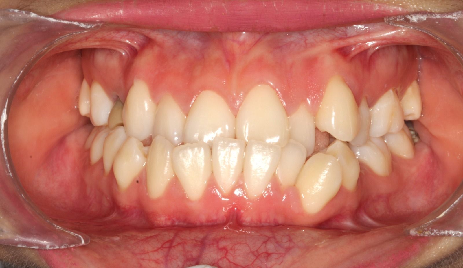 Primer plano de los dientes y las encías que muestra dientes frontales apiñados 