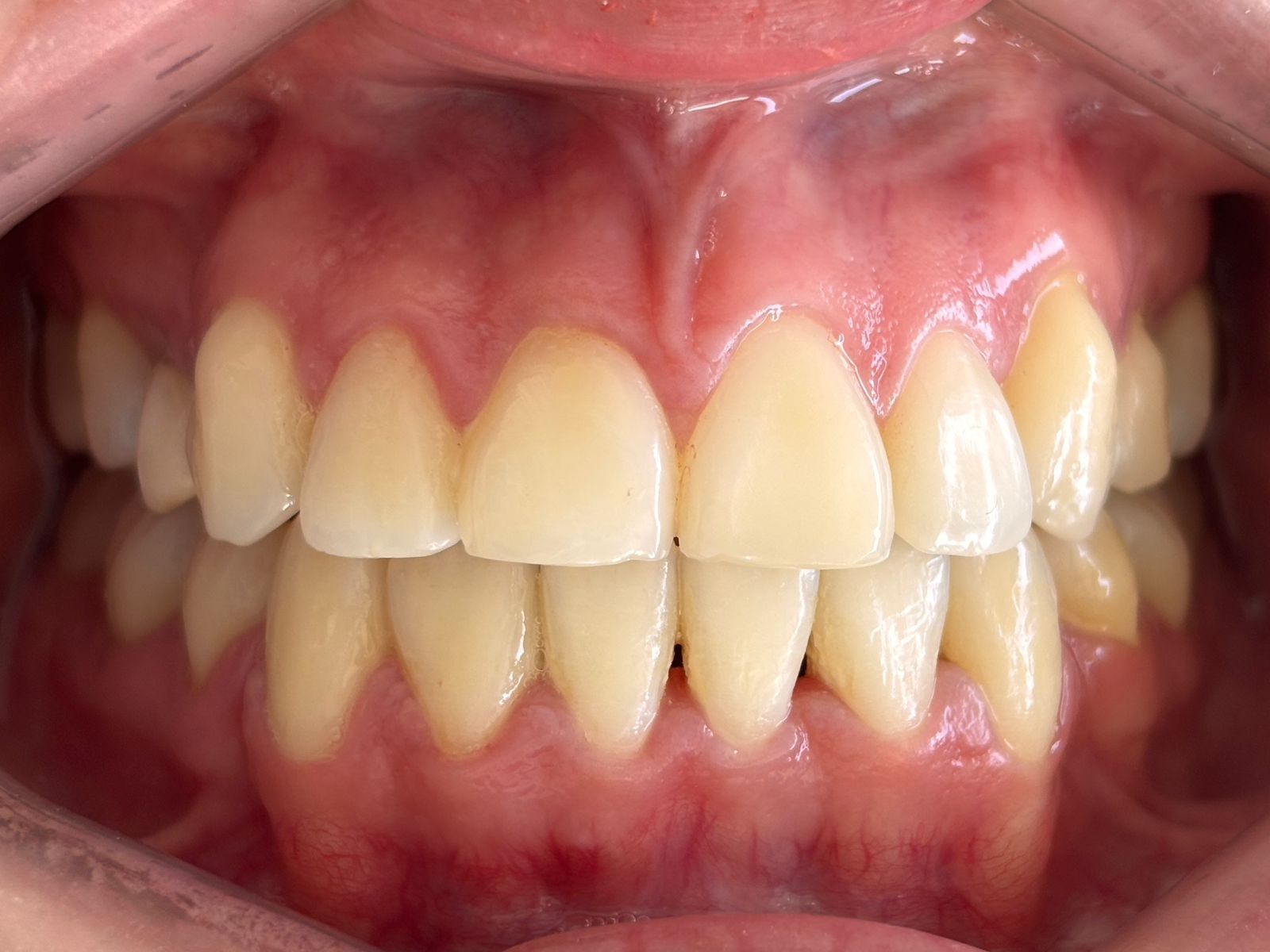 Primer plano de los dientes y las encías, mostrando una sonrisa completa con los labios entreabiertos.