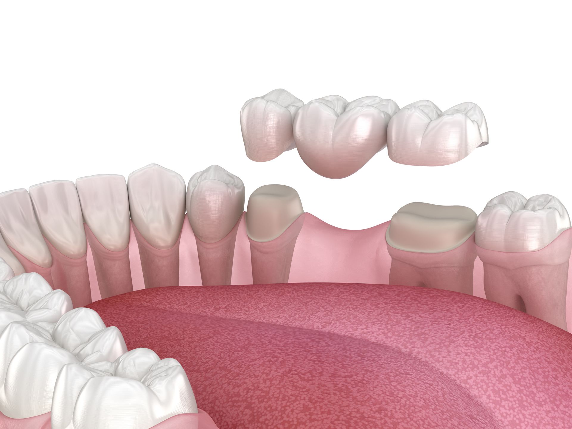 Pediatric Dental Crowns Maricopa, AZ