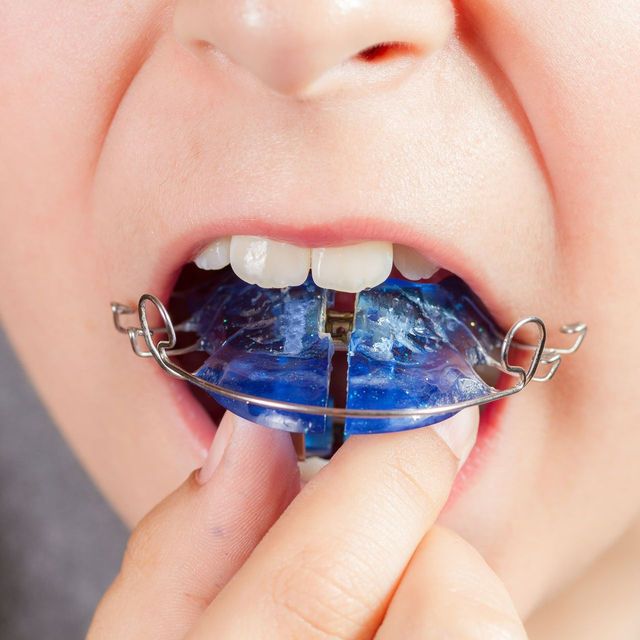 Oral Appliance Therapy in Maricopa, AZ | Super Smiles Maricopa