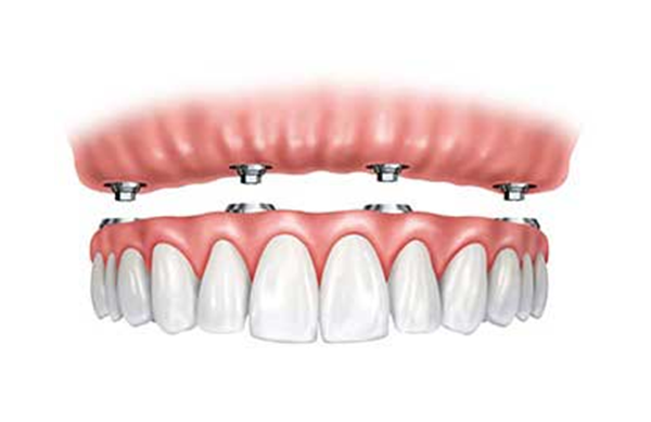 Dental Implants in Lynnwood WA 98036 Dental Implant Image | Dentist for dental implants and smile makeovers in Lynnwood WA 98036