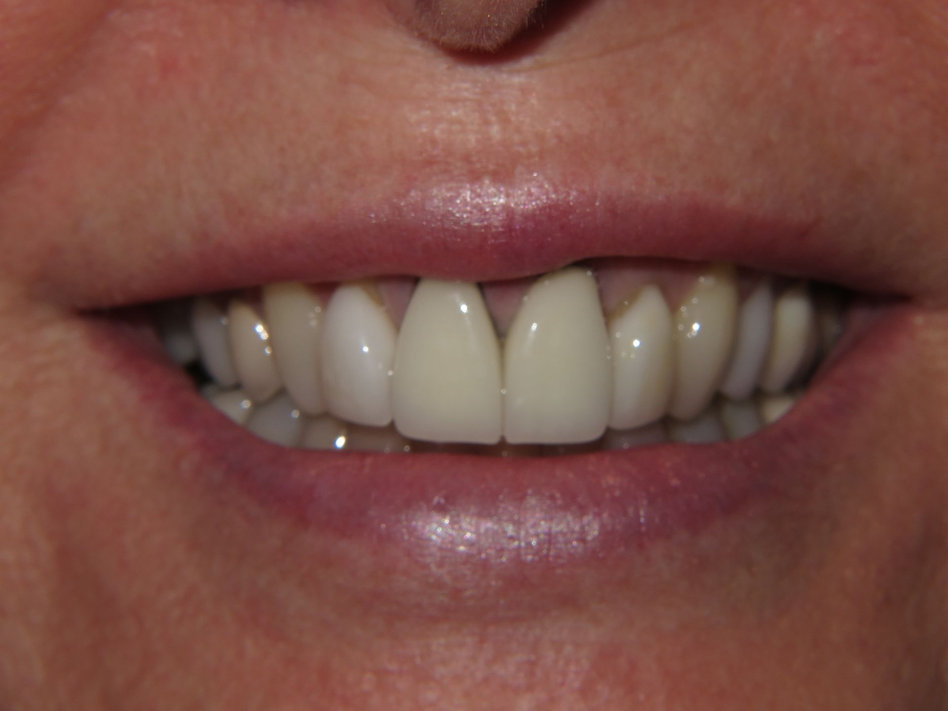Patient reviews | before teeth whitening in Lynnwood WA