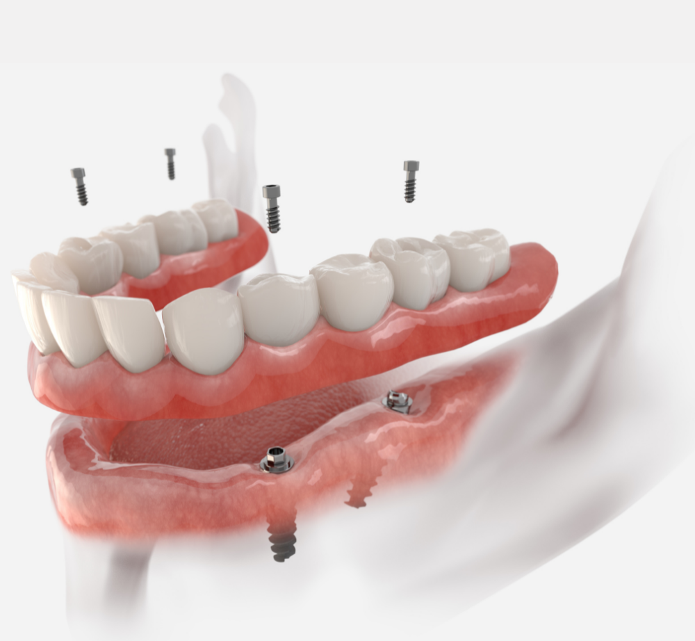 Get Dental Implants From Our Lynnwood WA Dentist The Dental Implant Procedure | Dentist in Lynnwood WA
