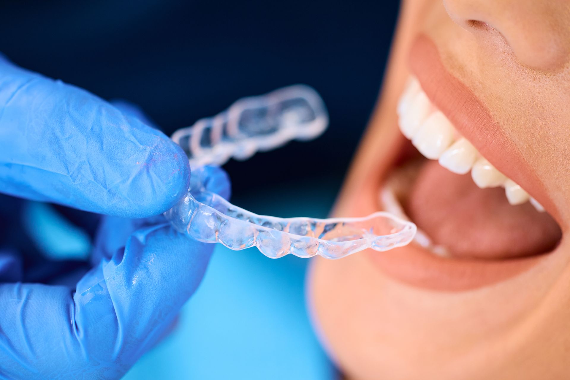 dentist taking out invisalign clear aligners from patient | lynnwood wa