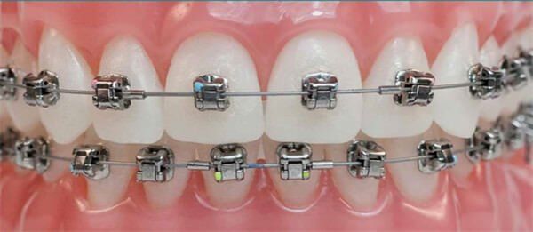 Limpieza Dental