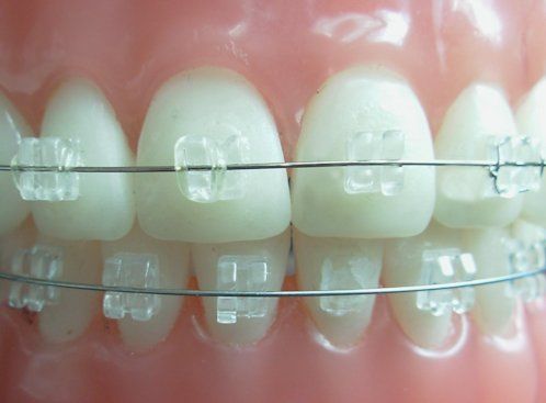 Brackets de cristal de zafiro Brackets de cristal de zafiro