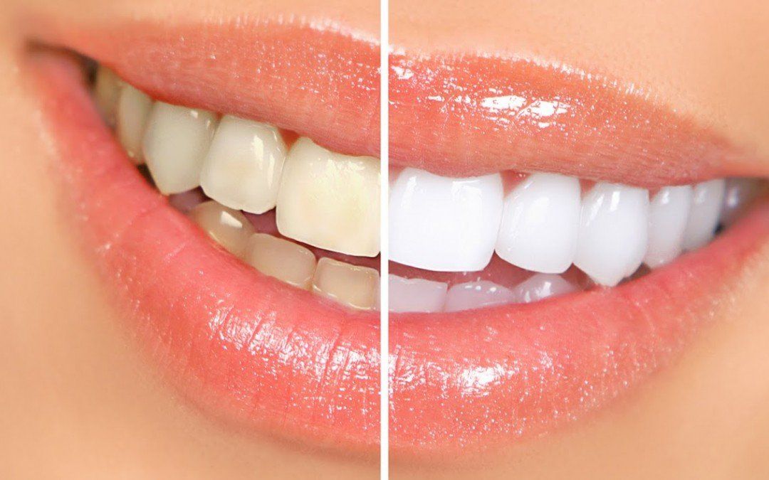 Blanqueamiento Dental Blanqueamiento Dental