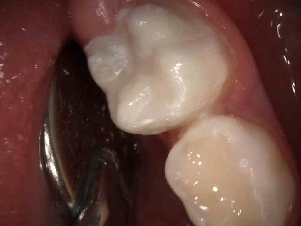 los dientes estan muy sensibles