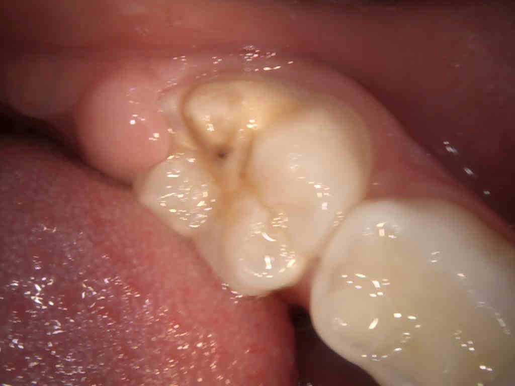 Los dientes de mi hijo se estan rompiendo