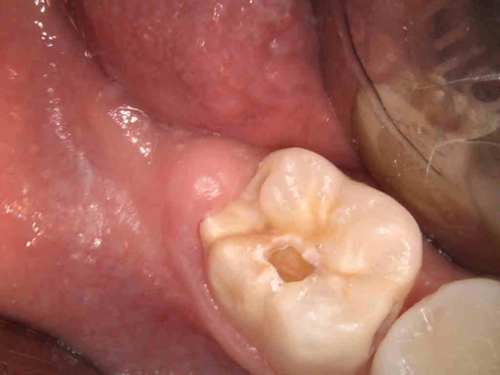 Fotografía clínica de opacidad demarcada en un molar permanente