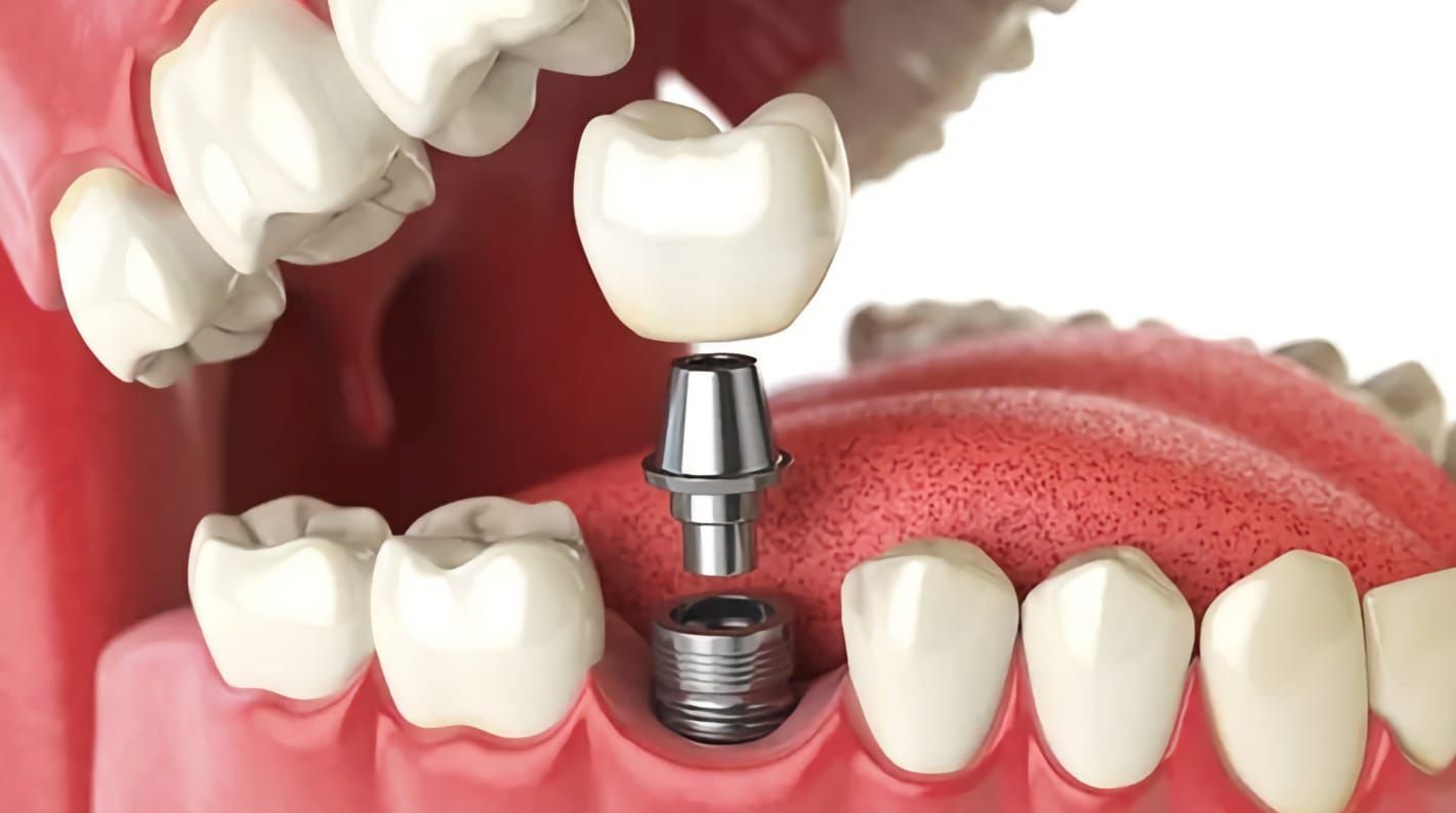 colocación tornillo implante dental en Guadalajara