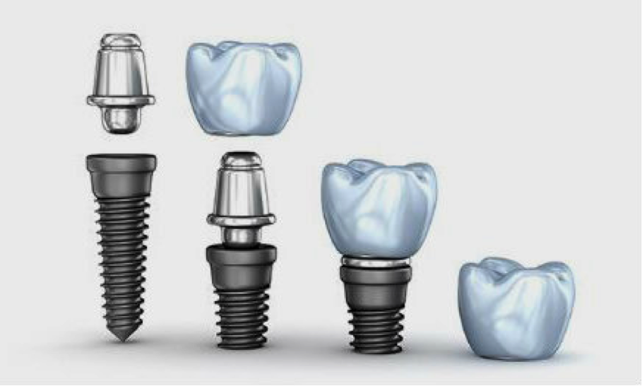 estructura implante dental osteointegrado
