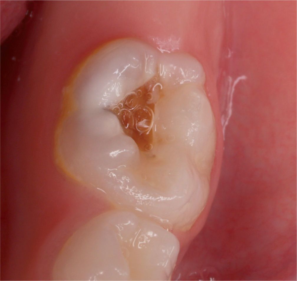 Como detener la caries en un diente