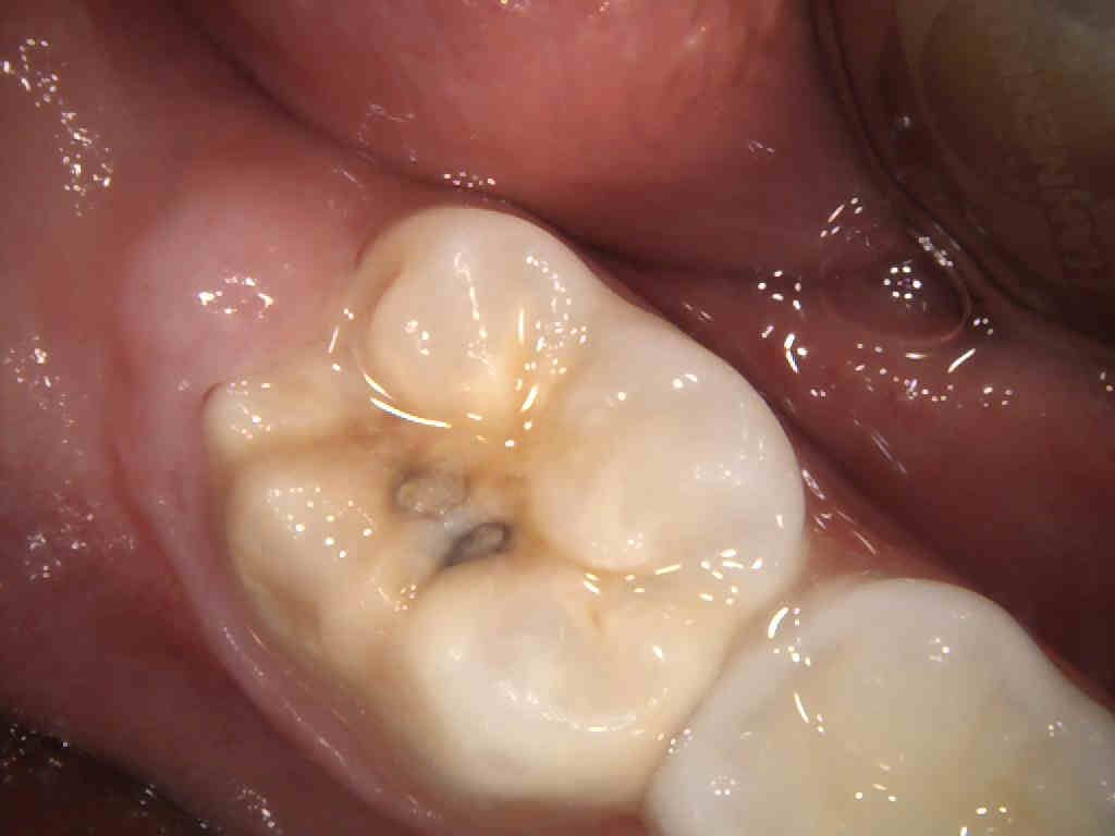 Dentista y paciente revisando diente
