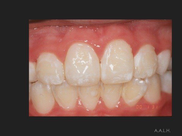 Un primer plano de los dientes de una persona con un fondo negro