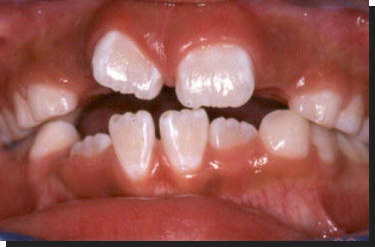 Un primer plano de los dientes de un niño al que le faltan algunos