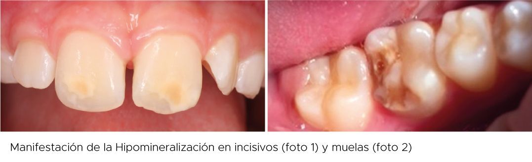 Una imagen de antes y después de los dientes de una persona