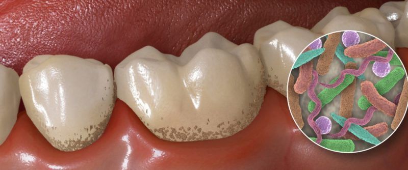 Un primer plano de los dientes de una persona y una imagen de las bacterias en la boca.
