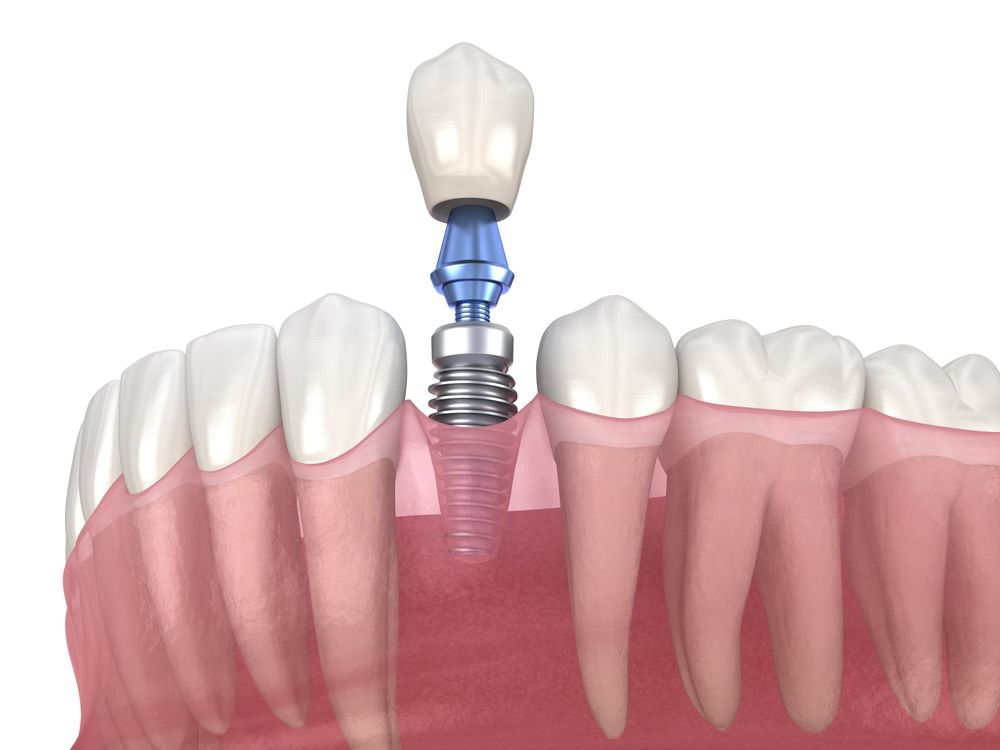 affordable dental implants Mexico