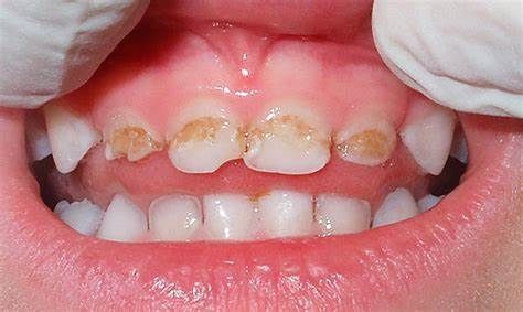 caries de primera infancia
