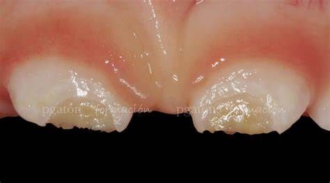 Un primer plano de los dientes de un bebé con un fondo negro.