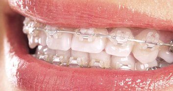 Brackets de autoligado Brackets de autoligado