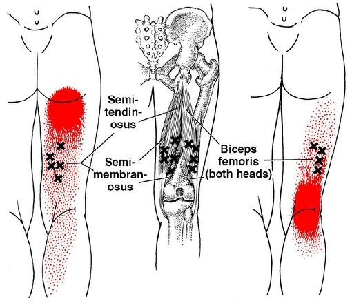A diagram of a person 's leg showing where the pain is located.