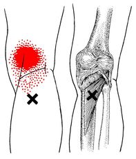 A black and white drawing of a person 's stomach and knee with x marks.