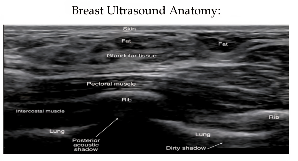 Breast ultrasound anatomy diagram with labeled tissue layers and muscle structures