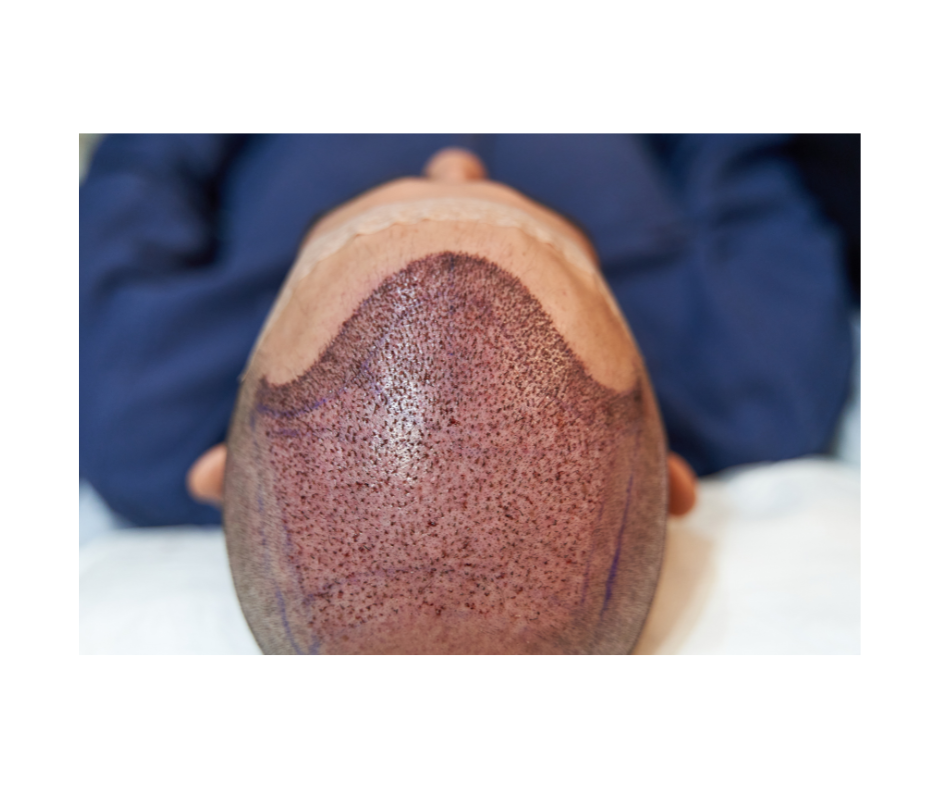 a close up of a man 's head with hair transplant surgery on it .