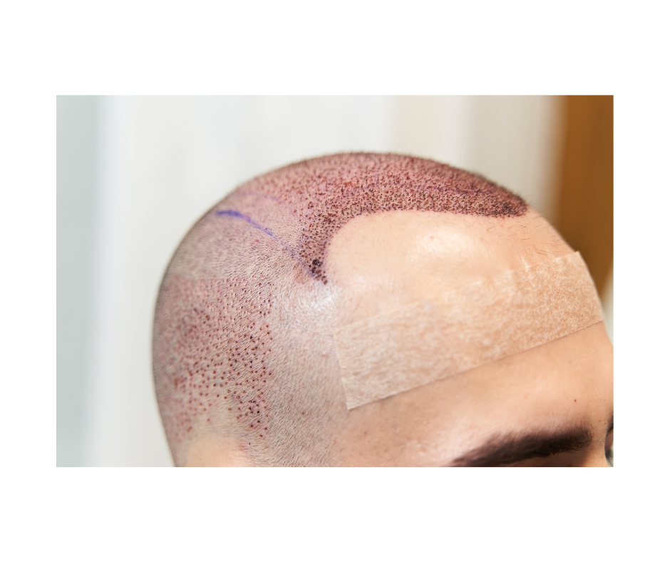 a man with a bandage on his head is getting a hair transplant .