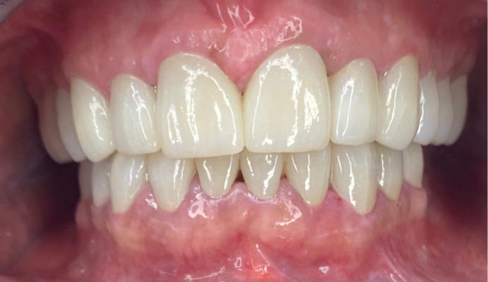 Close-up of a mouth showing white upper and lower teeth with pink gums and lips