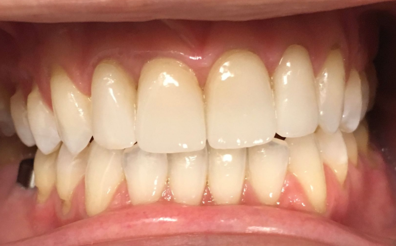 A close up of a person 's teeth with white teeth.