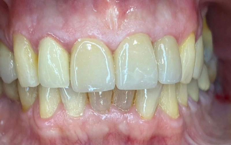Close-up of teeth and gums, showing a misaligned front tooth and yellowing enamel.